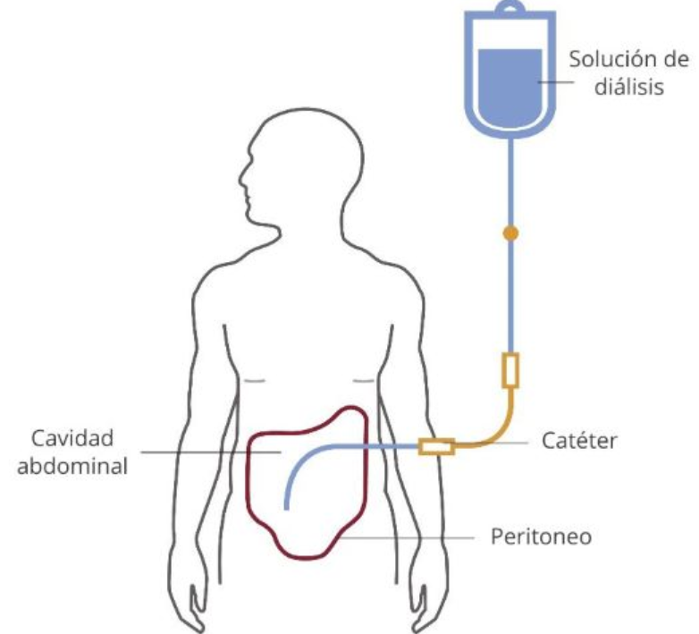 ¿Qué es la diálisis peritoneal? ¿Cómo funciona?